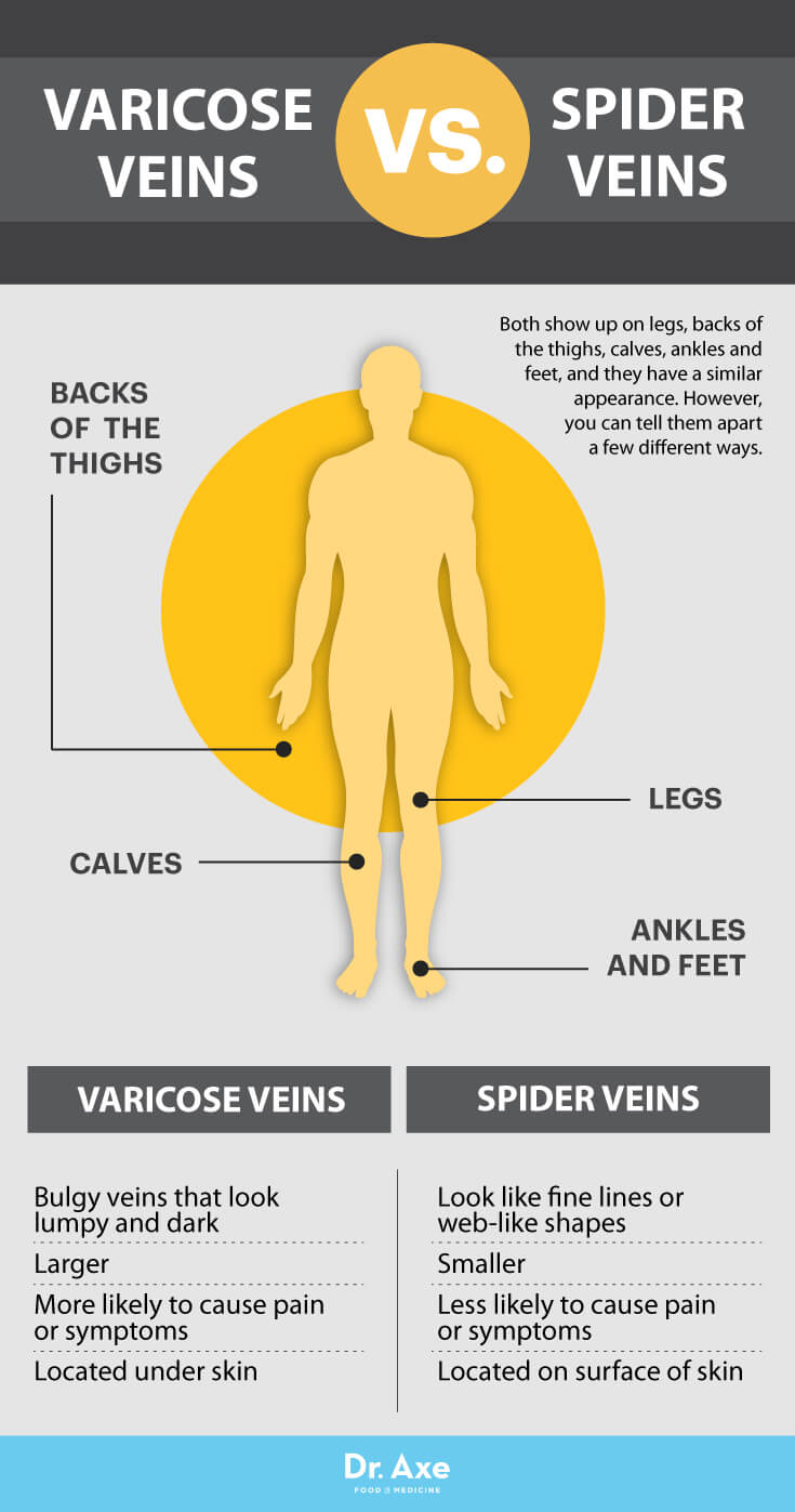 Varicose veins vs. spider veins - Dr. Axe